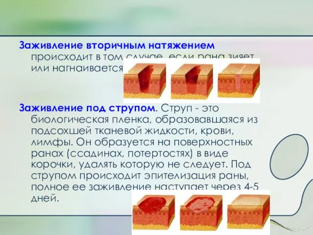 Заживление вторичным натяжением происходит в том случае, если рана зияет или