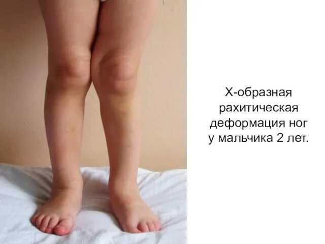 Х-образная рахитическая деформация ног у мальчика 2 лет.