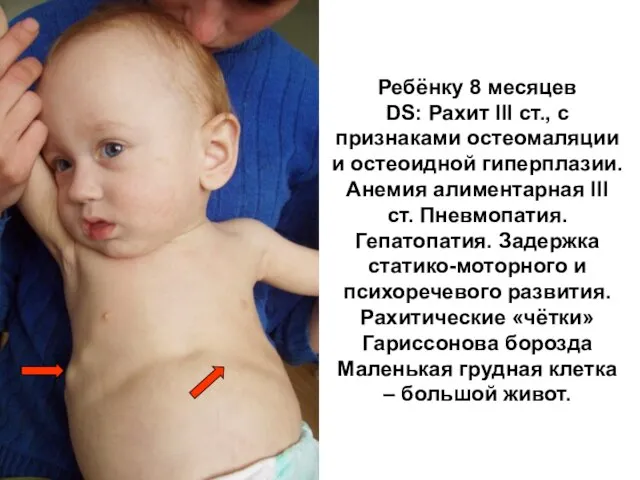Ребёнку 8 месяцев DS: Рахит III ст., с признаками остеомаляции и