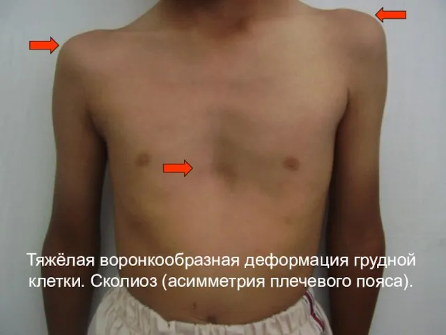 Тяжёлая воронкообразная деформация грудной клетки. Сколиоз (асимметрия плечевого пояса).