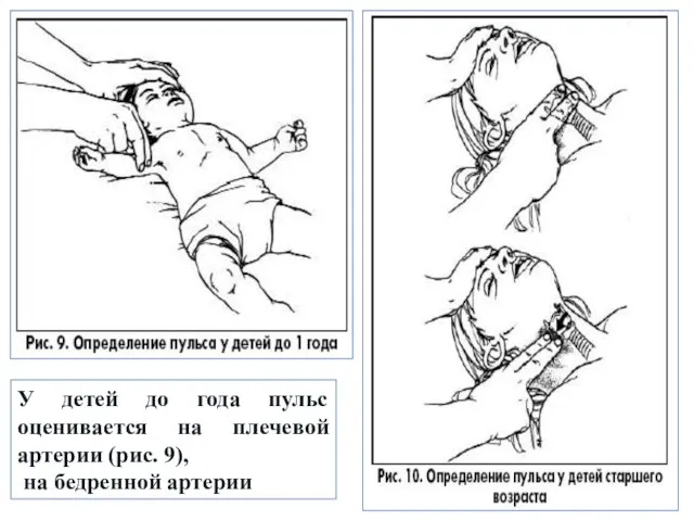 У детей до года пульс оценивается на плечевой артерии (рис. 9), на бедренной артерии