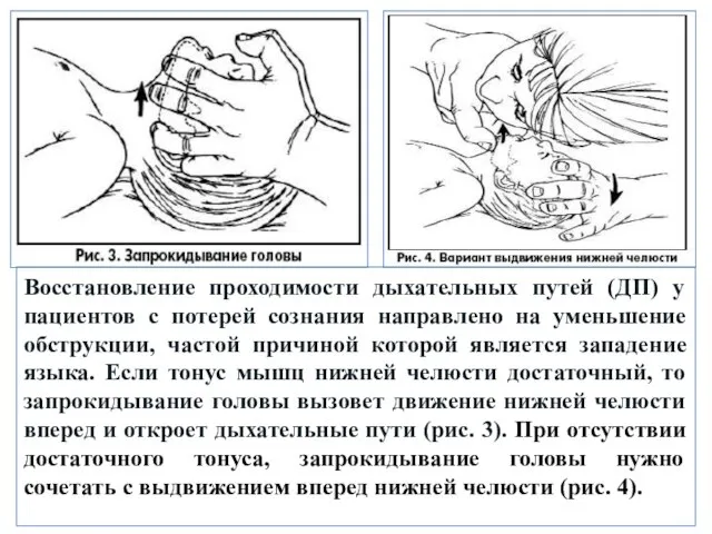 Восстановление проходимости дыхательных путей (ДП) у пациентов с потерей сознания направлено