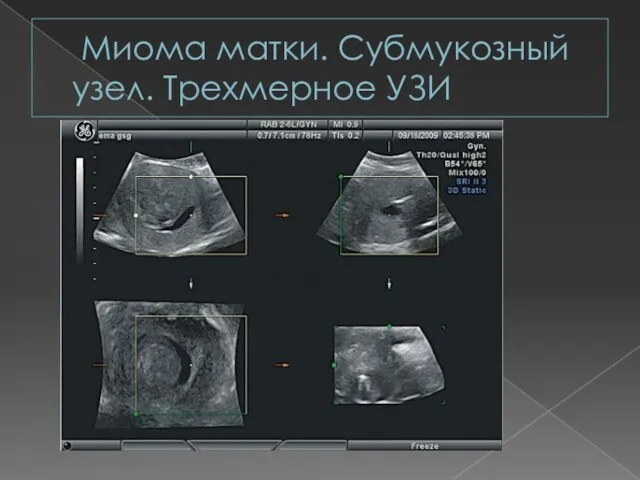 Миома матки. Субмукозный узел. Трехмерное УЗИ