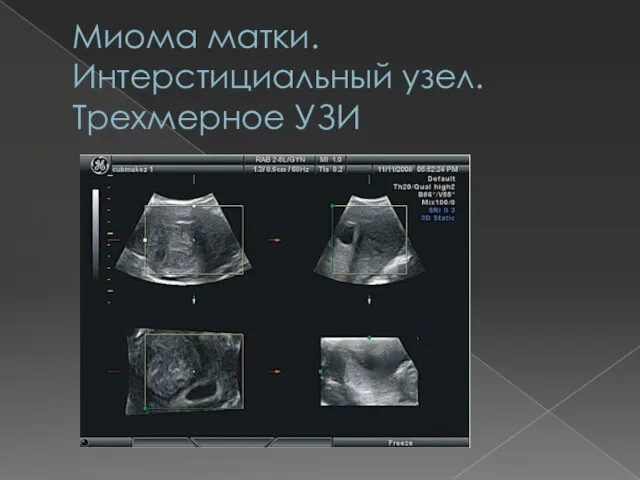 Миома матки. Интерстициальный узел. Трехмерное УЗИ