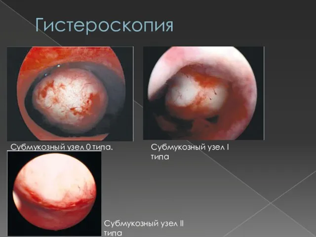Гистероскопия Субмукозный узел 0 типа. Субмукозный узел I типа Субмукозный узел II типа