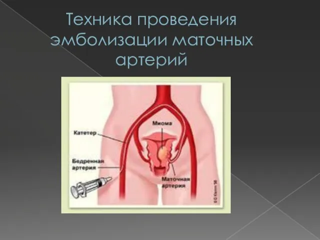 Техника проведения эмболизации маточных артерий