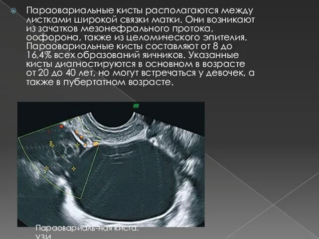 Параовариальные кисты располагаются между листками широкой связки матки. Они возникают из