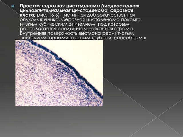 Простая серозная цистаденома (гладкостенная цилиоэпителиальная ци-стаденома, серозная киста; рис. 16.6) -