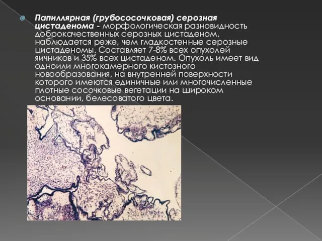 Папиллярная (грубососочковая) серозная цистаденома - морфологическая разновидность доброкачественных серозных цистаденом, наблюдается