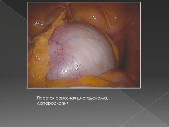 Простая серозная цистаденома. Лапароскопия