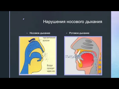 Нарушения носового дыхания Носовое дыхание Ротовое дыхание