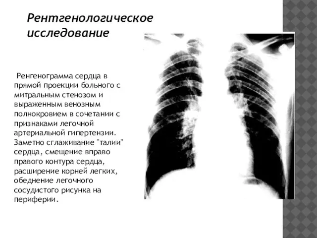 Рентгенологическое исследование Ренгенограмма сердца в прямой проекции больного с митральным стенозом