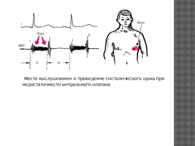 Место выслушивания и проведение систолического шума при недостаточности митрального клапана