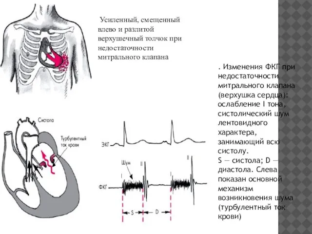 . Изменения ФКГ при недостаточности митрального клапана (верхушка сердца): ослабление I