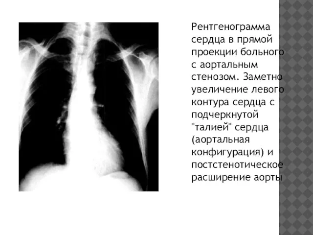 Рентгенограмма сердца в прямой проекции больного с аортальным стенозом. Заметно увеличение