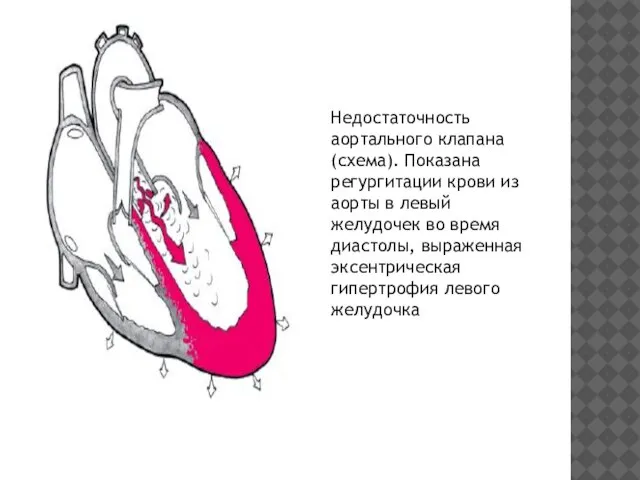 Недостаточность аортального клапана (схема). Показана регургитации крови из аорты в левый