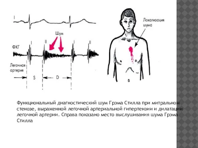 Функциональный диагностический шум Грэма Стилла при митральном стенозе, выраженной легочной артериальной