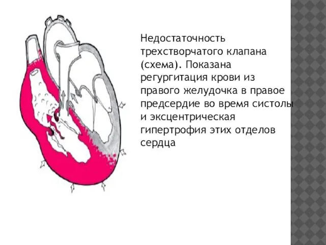 Недостаточность трехстворчатого клапана (схема). Показана регургитация крови из правого желудочка в