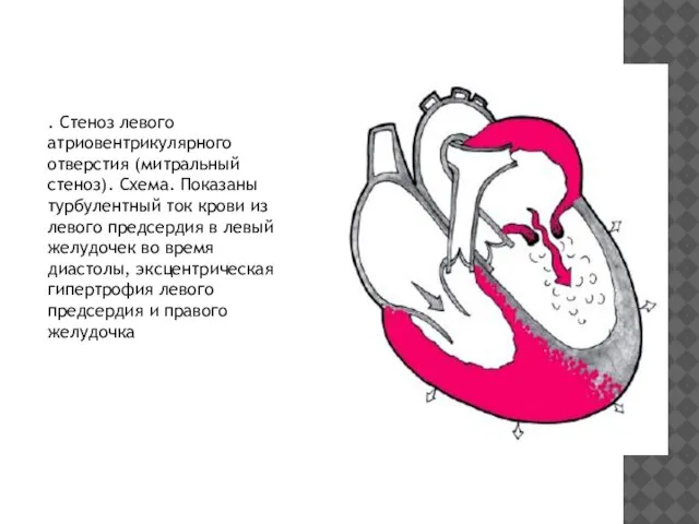 . Стеноз левого атриовентрикулярного отверстия (митральный стеноз). Схема. Показаны турбулентный ток