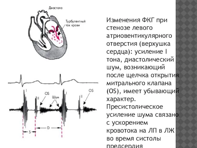 Изменения ФКГ при стенозе левого атриовентикулярного отверстия (верхушка сердца): усиление I