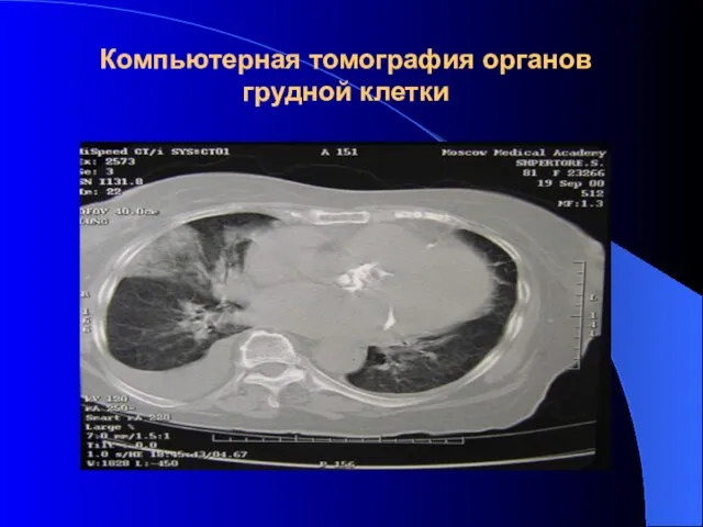 Компьютерная томография органов грудной клетки