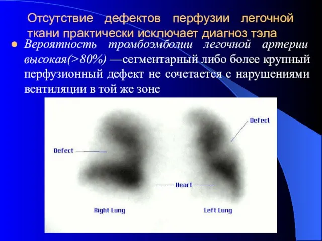 Отсутствие дефектов перфузии легочной ткани практически исключает диагноз тэла Вероятность тромбоэмболии