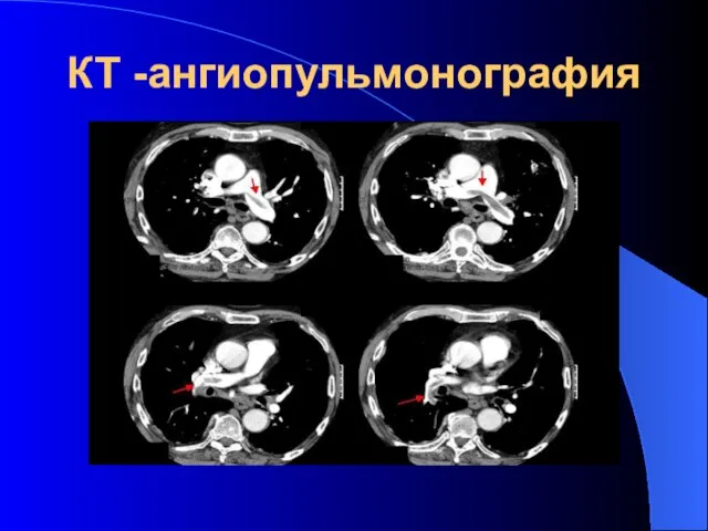 КТ -ангиопульмонография