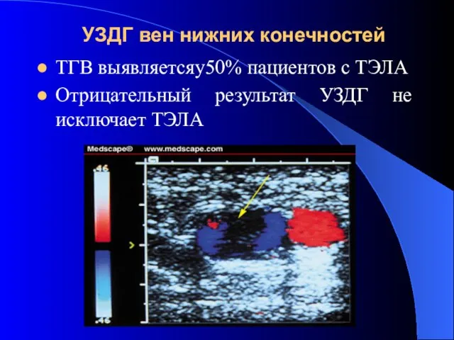 УЗДГ вен нижних конечностей ТГВ выявляетсяу50% пациентов с ТЭЛА Отрицательный результат УЗДГ не исключает ТЭЛА