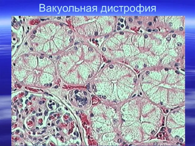 Вакуольная дистрофия