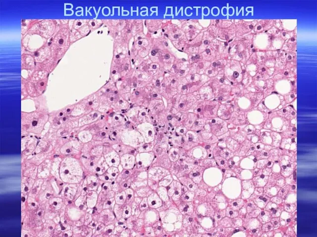 Вакуольная дистрофия