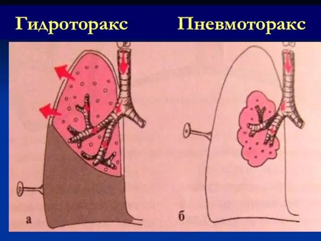 Гидроторакс Пневмоторакс