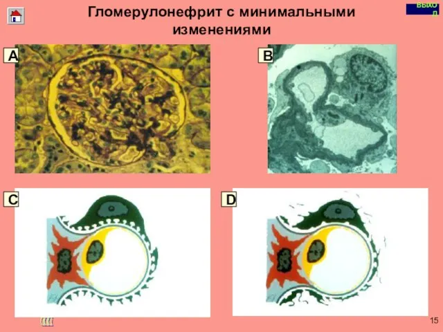 Copyright © I-Design 2002 Гломерулонефрит с минимальными изменениями