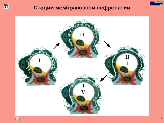 Copyright © I-Design 2002 Стадии мембранозной нефропатии