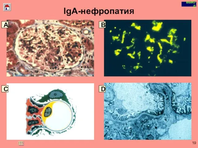 Copyright © I-Design 2002 IgA-нефропатия