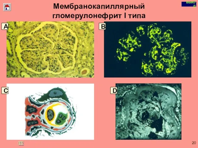 Copyright © I-Design 2002 Мембранокапиллярный гломерулонефрит I типа