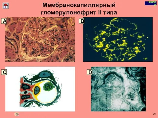 Copyright © I-Design 2002 Мембранокапиллярный гломерулонефрит II типа