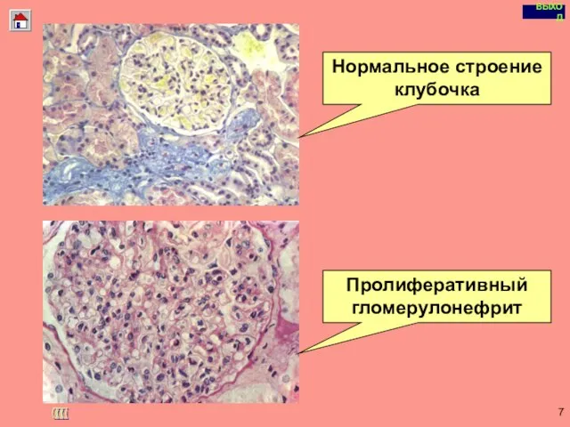 Copyright © I-Design 2002 Морфологические изменения в почках при остром ГН Нормальное строение клубочка Пролиферативный гломерулонефрит