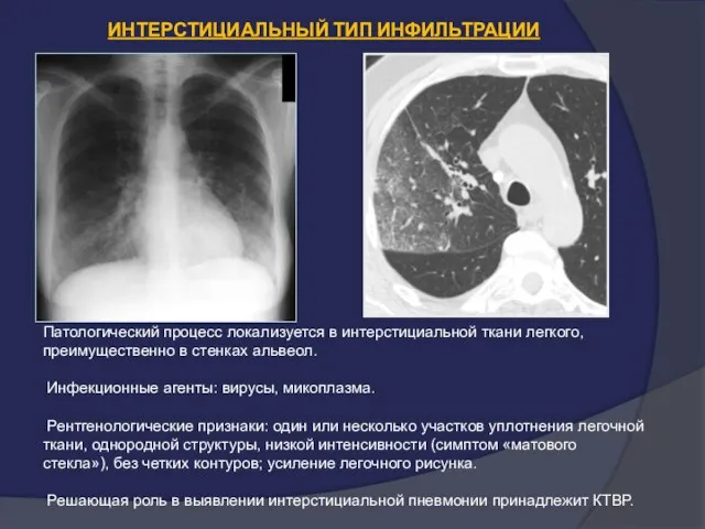 ИНТЕРСТИЦИАЛЬНЫЙ ТИП ИНФИЛЬТРАЦИИ Патологический процесс локализуется в интерстициальной ткани легкого, преимущественно