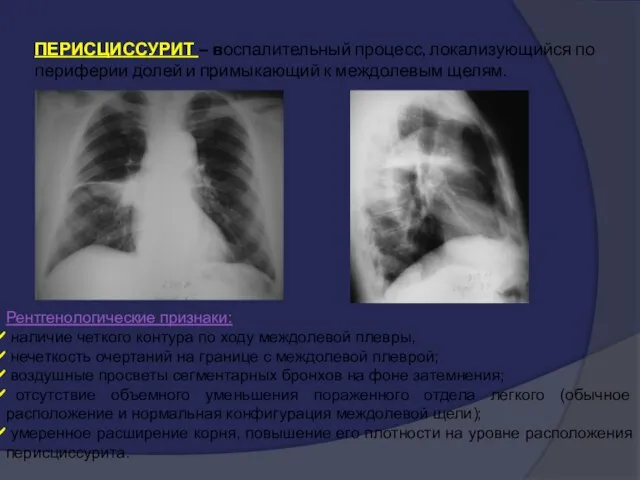 ПЕРИСЦИССУРИТ – воспалительный процесс, локализующийся по периферии долей и примыкающий к