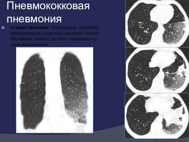 Пневмококковая пневмония стадия прилива: диффузное снижение прозрачности участка легочной ткани без