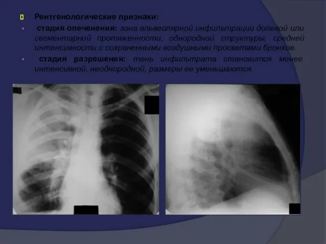 Рентгенологические признаки: стадия опеченения: зона альвеолярной инфильтрации долевой или сегментарной протяженности,