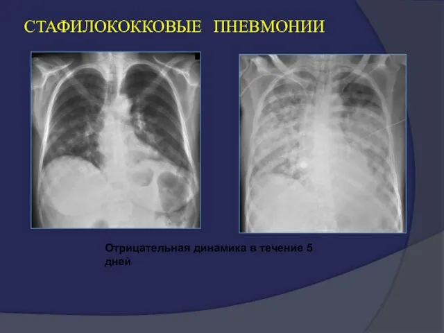 СТАФИЛОКОККОВЫЕ ПНЕВМОНИИ Отрицательная динамика в течение 5 дней