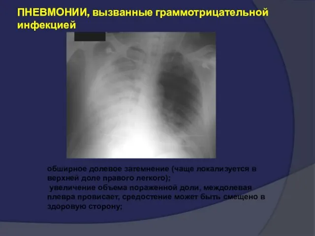 ПНЕВМОНИИ, вызванные граммотрицательной инфекцией обширное долевое затемнение (чаще локализуется в верхней