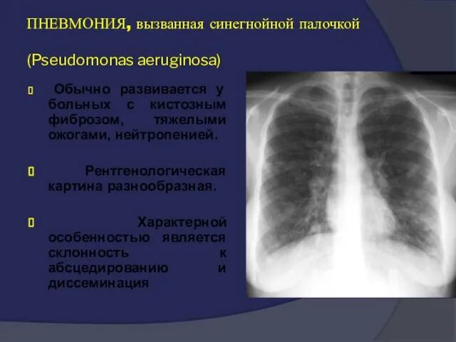 ПНЕВМОНИЯ, вызванная синегнойной палочкой (Pseudomonas aeruginosa) Обычно развивается у больных с