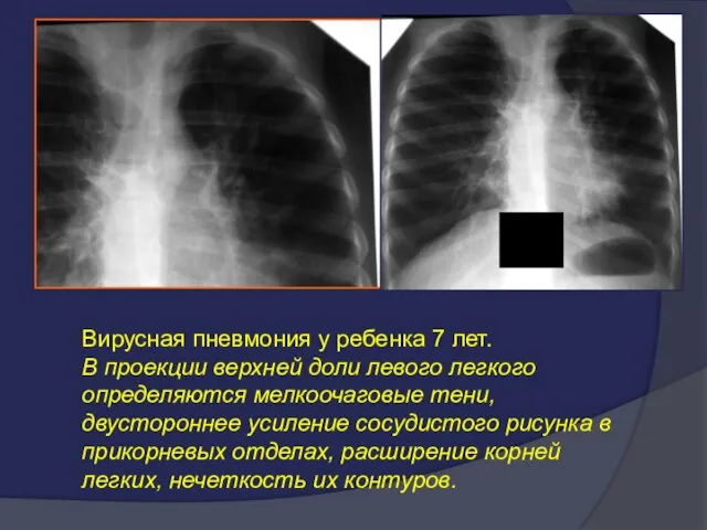 Вирусная пневмония у ребенка 7 лет. В проекции верхней доли левого