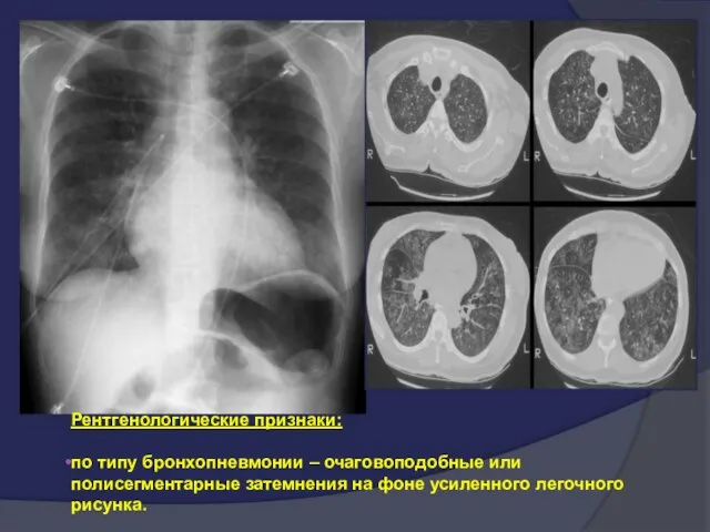 Рентгенологические признаки: по типу бронхопневмонии – очаговоподобные или полисегментарные затемнения на фоне усиленного легочного рисунка.