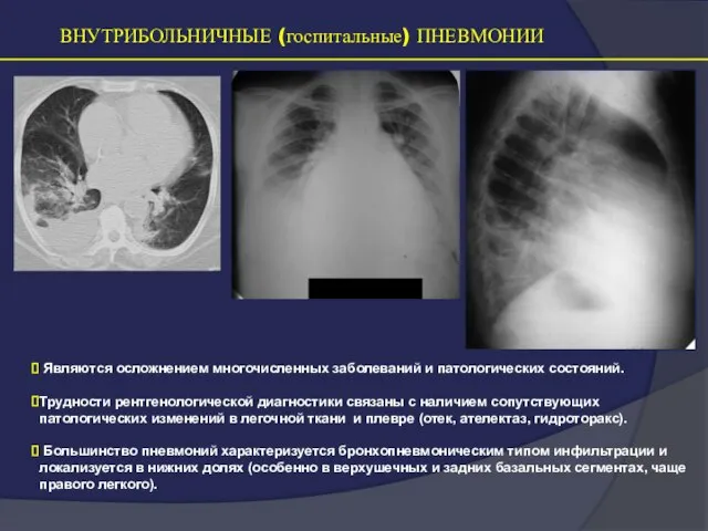 ВНУТРИБОЛЬНИЧНЫЕ (госпитальные) ПНЕВМОНИИ Являются осложнением многочисленных заболеваний и патологических состояний. Трудности