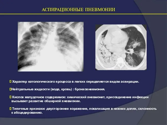 АСПИРАЦИОННЫЕ ПНЕВМОНИИ Характер патологического процесса в легких определяется видом аспирации. Нейтральные