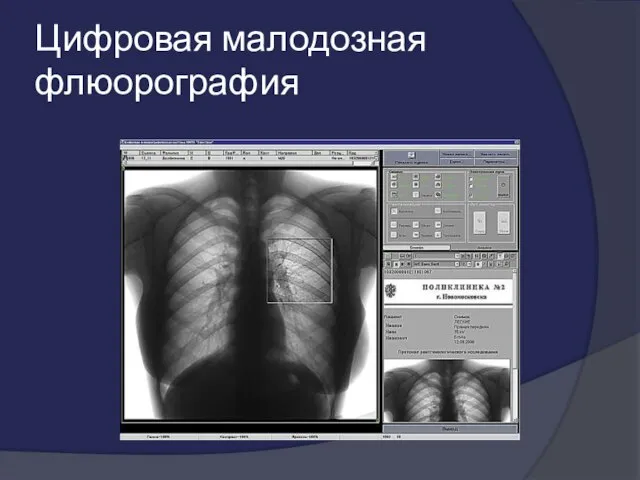 Цифровая малодозная флюорография