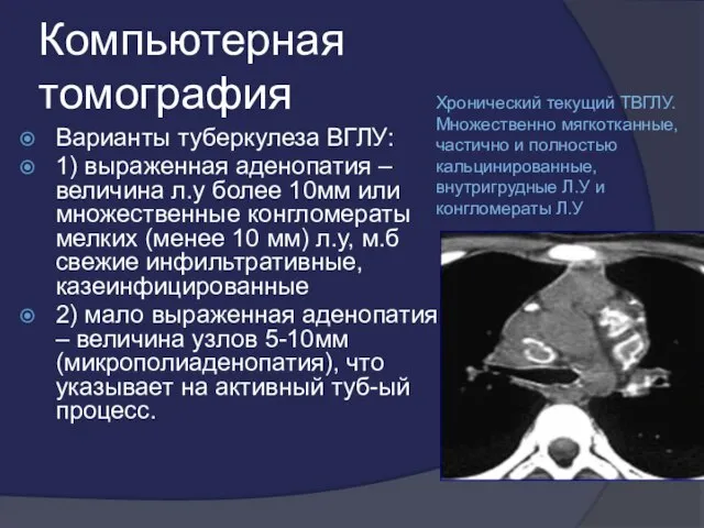 Компьютерная томография Варианты туберкулеза ВГЛУ: 1) выраженная аденопатия – величина л.у